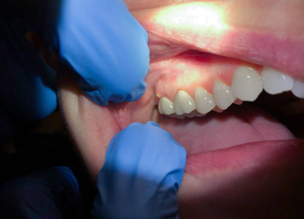 Best Emergency Wisdom Tooth Extraction in Floydada, TX